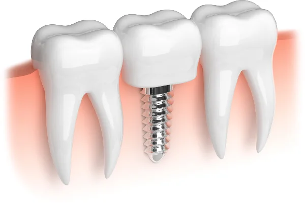 Dental Implant